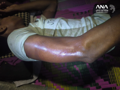 Injuries to the body of one of the kidnapped Rohingyas (Image: ANA)